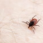 Closeup of dog tick on human skin surface.
